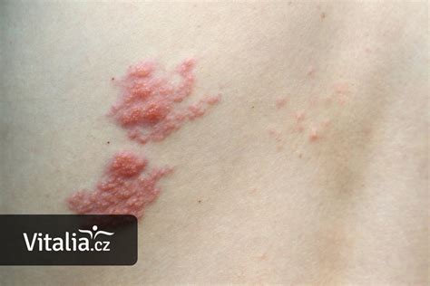 Pásový opar (Herpes Zoster) a jeho súvislosti s tehotenstvom: Príznaky a liečba